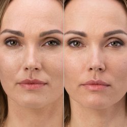 Balanced Beauty Med Spa - RHA- the most natural filler on the market