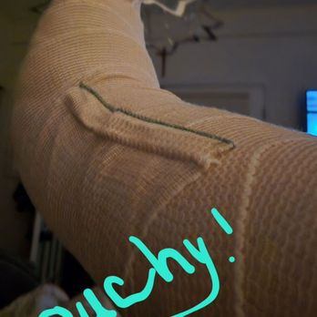 Great Lakes Orthopaedic Center - This is the cast from the 3rd operation. He did 3 surgeries here too. - Sports Medicine Near Me - Traverse City, Michigan Great Lakes Orthopaedic Center - This is the cast from the 3rd operation. He did 3 surgeries here too. - Sports Medicine Near Me - Traverse City, Michigan