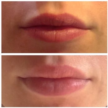 Congressional Plastic Surgery | Christopher C. Chang, M.D - Before and after lip fillers! - Cosmetic Surgeons Near Me - Vienna, Virginia Congressional Plastic Surgery | Christopher C. Chang, M.D - Before and after lip fillers! - Cosmetic Surgeons Near Me - Vienna, Virginia