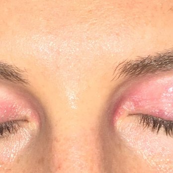 Optimal Health & Wellness - Constant (completely random) rashes all over eyelids. - Naturopathic/Holistic Near Me - Pasadena, California Optimal Health & Wellness - Constant (completely random) rashes all over eyelids. - Naturopathic/Holistic Near Me - Pasadena, California