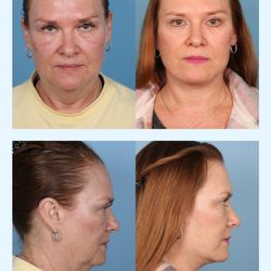 Douglas Sidle, MD - Northwestern Medicine - Deep Plane Facelift & Neck Lift, Before & After.