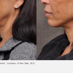 Vivaa - Lower face tightening with Profound RF- no surgery and minimal down time.