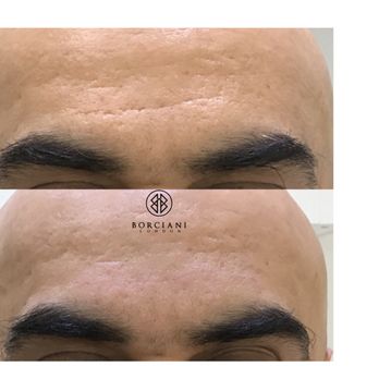 Borciani London - scar reduction - Permanent Makeup Near Me - London, XGL Borciani London - scar reduction - Permanent Makeup Near Me - London, XGL