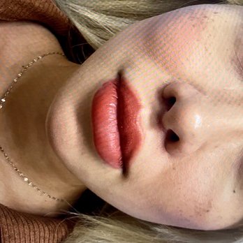 Benjamin C Chu, MD - After distance between top lip and nose 12 mm - Cosmetic Surgeons Near Me - Honolulu, Hawaii Benjamin C Chu, MD - After distance between top lip and nose 12 mm - Cosmetic Surgeons Near Me - Honolulu, Hawaii