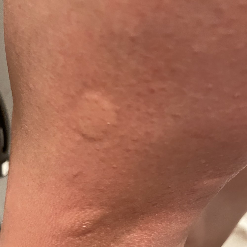 Kimpton Surfcomber Hotel - Wife's legs with ant bites. - Hotels Near Me - Miami Beach, Florida Kimpton Surfcomber Hotel - Wife's legs with ant bites. - Hotels Near Me - Miami Beach, Florida