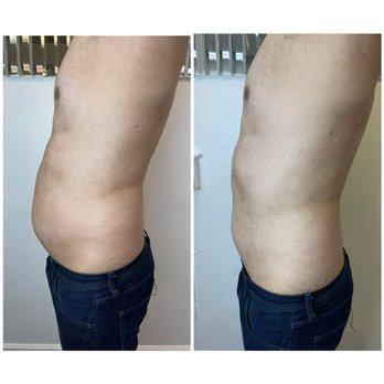 Build A Bitch Aesthetics - This was literally taken right before and after the session. Instant results! - Skin Care Near Me - Nashville, Tennessee
