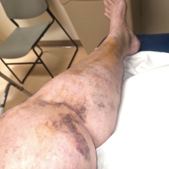 Excelsior Orthopaedics - Swelling and bruising 3 times its normal size. - Sports Medicine Near Me - Amherst, New York Excelsior Orthopaedics - Swelling and bruising 3 times its normal size. - Sports Medicine Near Me - Amherst, New York