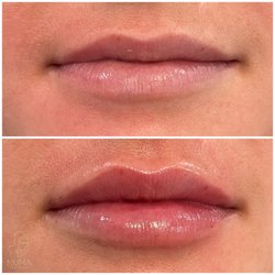 Numa Aesthetics - Lip enhancement using a microcannula. Swelling will begin to resolve in a few days. **no bruising**