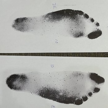 The Good Feet Store - My "before" impressions. Yes... they hurt badly, and I had been characterized as having Donald Duck feet. - Orthotics Near Me - Buford, Georgia The Good Feet Store - My "before" impressions. Yes... they hurt badly, and I had been characterized as having Donald Duck feet. - Orthotics Near Me - Buford, Georgia