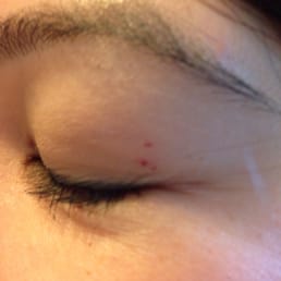 Scabs from the threading I received from one of the women.. She was really rough. Scabs from the threading I received from one of the women.. She was really rough.
