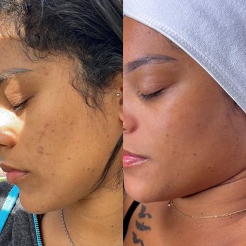 Rosi Delicoli  - Deep pore cleansing + Peels + homecare lira products - Estheticians Near Me - Lafayette, California