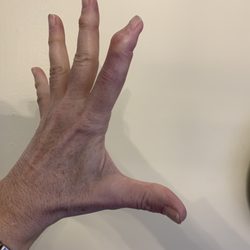 Columbus Bone, Joint & Hand Surgeons, Inc - 4 months post op