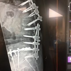 Pain Management Specialists - This is my back and part of my hip hardware. Horrific - I'm only 61.