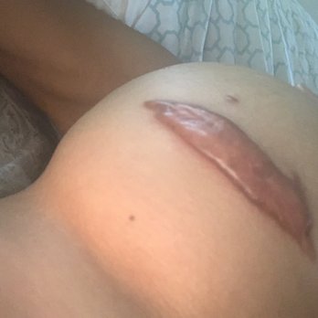 Daniel J. Casper, M.D - Huge keloid way too far up my breast and scalpel scratches 2 years later! Even after keloid treatment - Cosmetic Surgeons Near Me - Pasadena, California