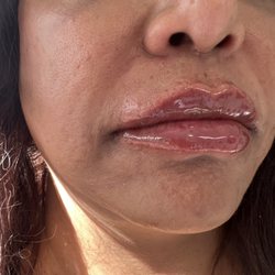 Fancy Aesthetics - Full and Plump Lips (Juvederm Ultra XC)