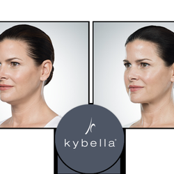 We can help you get rid of an unwanted double chin with Kybella treatments.