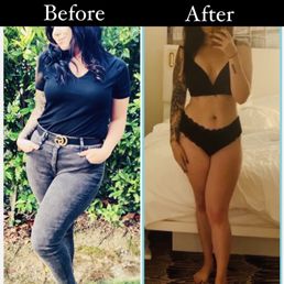 Before Coolsculpting vs final results! Done by Raeleen