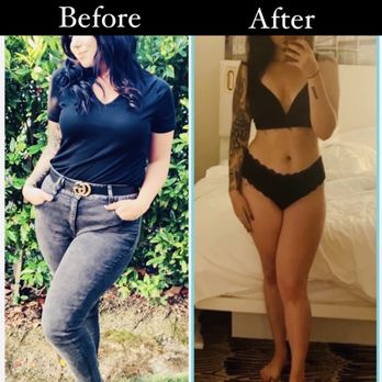 OrangeTwist - Brea - Before Coolsculpting vs final results! Done by Raeleen - Medical Spas Near Me - Brea, California