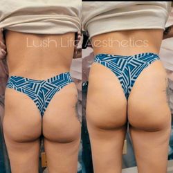 Non surgical BBL, before and after.