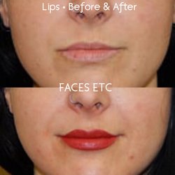 Faces Etc - Lips - Before & After