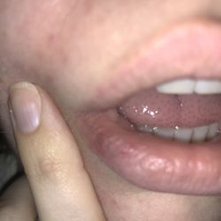 Bright Now Dental & Orthodontics - Mission Viejo - Cut lip