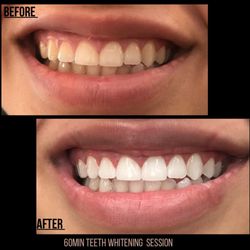 The Whitening Studio - 60min teeth whitening session