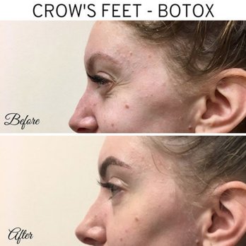Metropolitan Dermatology - Botox injections before and after results. - Dermatologists Near Me - Southampton Township, New Jersey Metropolitan Dermatology - Botox injections before and after results. - Dermatologists Near Me - Southampton Township, New Jersey