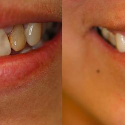 Elite Dental Care - Before and After from Elite Dental Care | Eads, TN