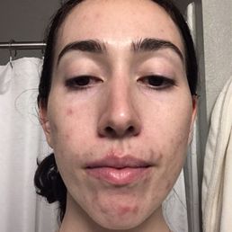 This was my skin when I first went to Lauree This was my skin when I first went to Lauree