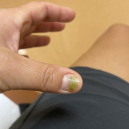 Left thumb with nail fungus from Vera nails