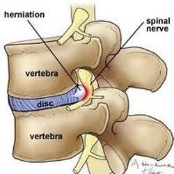 Gallatin Chiropractic Clinic - Disc Herniation causing spinal nerve irritation.
