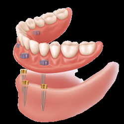 Artistic Denture - Implant Supported Denture