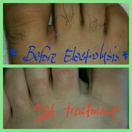 1st treatment on toes. Love it so far 1st treatment on toes. Love it so far