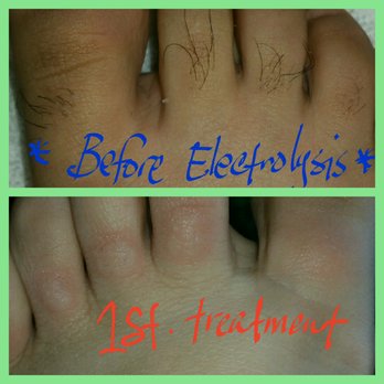 Eden Electrolysis - 1st treatment on toes. Love it so far - Hair Removal Near Me - San Jose, California Eden Electrolysis - 1st treatment on toes. Love it so far - Hair Removal Near Me - San Jose, California