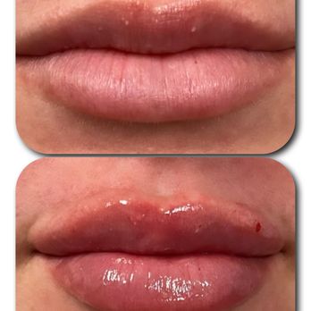 Artem Med Spa - Confidence amplified. Lip filler magic in motion.  #LusciousLips #confidentcontours - Medical Spas Near Me - Solana Beach, California