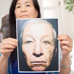 Anita Wang, MD - Retired Trucker, living side by side example of the effects of sun damage