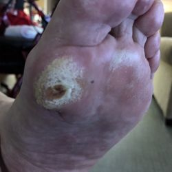 Genesis Senior Living - And this was 7 weeks later. The staff says she's "healed"!! REALLY???