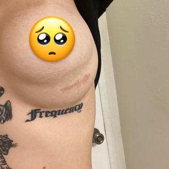 Imagine Plastic Surgery Center - This is my left breast where my implant had fallen out from my breast pocket right after surgery. Pic was taken months after. - Cosmetic Surgeons Near Me - Riverside, California