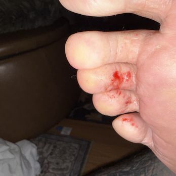 Sun Nail Spa - Callus remover applied between toes and ate thu my skin layers til raw meat. Unprofessional. - Nail Salons Near Me - Las Vegas, Nevada