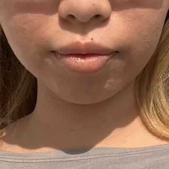 Krateera Studio - Before - Skin Care Near Me - San Fernando Valley, California Krateera Studio - Before - Skin Care Near Me - San Fernando Valley, California