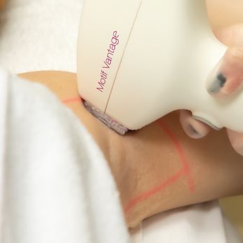 Epiderma - Chez Epiderma, notre réputation n'est plus à faire en matière d'épilation par laser. Ce traitement médico-esthétique est notr... - Medical Spas Near Me - Laval, Quebec