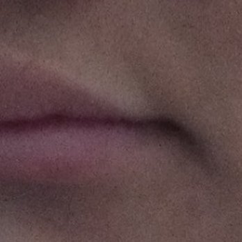 Bella Medspa And Aesthetics - Left side of the lip is smaller than right side. - Beauty & Spas Near Me Bella Medspa And Aesthetics - Left side of the lip is smaller than right side. - Beauty & Spas Near Me