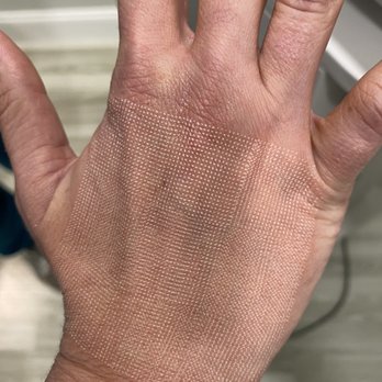 Rejuv Aesthetics - CO2 laser of the hand immediately after treatment. - Medical Spas Near Me - Delray Beach, Florida Rejuv Aesthetics - CO2 laser of the hand immediately after treatment. - Medical Spas Near Me - Delray Beach, Florida