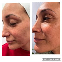 RMJ Medical - Left before and right after vampire facial 2 weeks plumping very noticeable and beautiful results