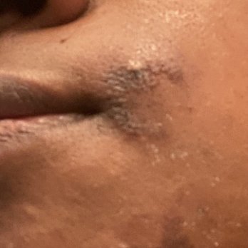 Monarch - Laser burn - Medical Spas Near Me - Granite Bay, California Monarch - Laser burn - Medical Spas Near Me - Granite Bay, California