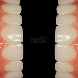 Dental Expressions - A Smile with All-on-5 dental implants