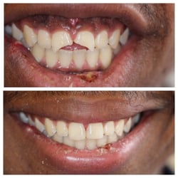 Angela Aaron, DDS - Patient came in with 2 broken front teeth, after an hour in chair Dr. Aaron's results speak for themselves.