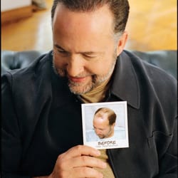 Bosley Hair Restoration & Transplant - Actual Patient
