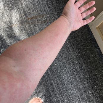 Kauai Urgent Care - Allergic reaction from the bee sting or sun screen I was using. - Urgent Care Near Me - Lihue, Hawaii Kauai Urgent Care - Allergic reaction from the bee sting or sun screen I was using. - Urgent Care Near Me - Lihue, Hawaii