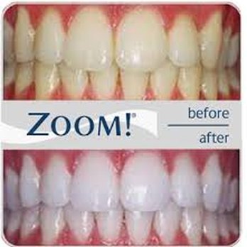 Jerry A Sanchez, DDS - Up to 8 shades lighter! - Cosmetic Dentists Near Me - Pleasanton, California Jerry A Sanchez, DDS - Up to 8 shades lighter! - Cosmetic Dentists Near Me - Pleasanton, California